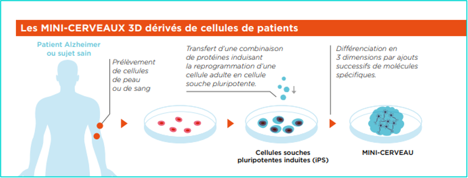 Quels sont les traitements de la maladie d'Alzheimer