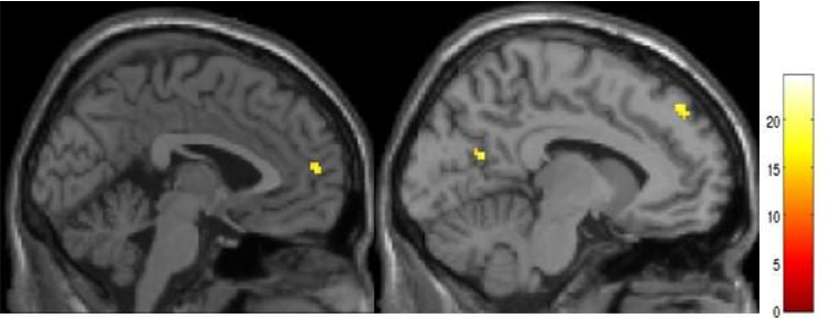 Quels sont les mécanismes biologiques de la dépression