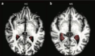 Les plexus choroïdes (encerclés en rouge) des patients atteints de la forme rémittente de la SEP sont plus grands (à droite) que ceux des témoins sains (à gauche).