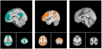 Coupes de cerveau