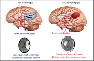 Les conséquences de l'AVC