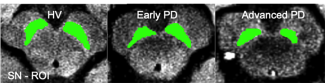 Diagnostic de Parkinson en IRM