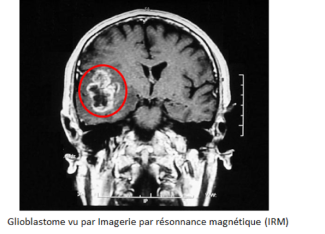 Glioblastome vu par Imagerie par résonnance magnétique (IRM)