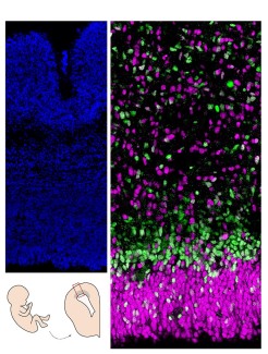 Coupe de cerveau humain (cortex). A gauche, les noyaux sont marqués en bleu; à droite, les cellules progénitrices en magenta sont moins engagées dans la différentiation neuronale que celles en vert. © Monia Barnat/Grenoble Institut des Neurosciences/Inserm, Université Grenoble Alpes