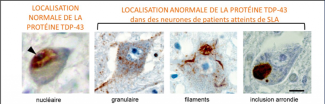 Localisation normale et anormale de la protéine TDP-43