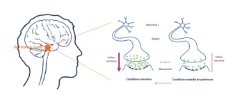 Schéma des mécanismes biologiques de la maladie de Parkinson