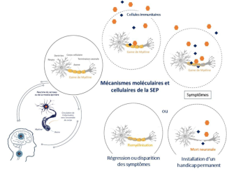 mécanisme de la sclérose en plaques