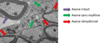 Une réparation de la myéline