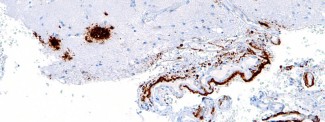 Cerebral amyloid angiopathy ©CC BY-SA 3.0