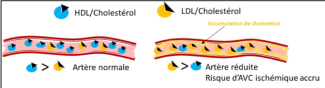 Différence entre artère normale et artère réduite
