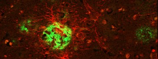 Expression du récepteur P2X7 autour des lésions amyloïdes dans le cerveau de patients atteints de maladie d'Alzheimer.