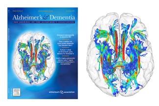 Illustration – crédit photo © Michel Thiebaut de Schotten (Institut du Cerveau) et Harald Hampel (IM2A – Institut du Cerveau)