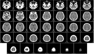 DFT sur un cerveau