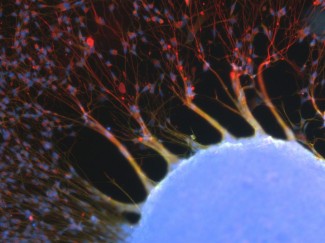 Cellules souches de gliomes (CSG) se différenciant en quittant leur neurosphère (amas cellulaire en bas à droite).