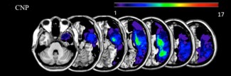 Superposition des lésions des 17 patients cérébro-lésés du coté droit inclus dans l’étude et présentant une négligence chronique (CNP : chronic neglect patients). Les lésions sont imagées par IRM (Imagerie par Résonance Magnétique) à différents niveaux du cerveau. © Lunven et al, Paolo BARTOLOMEO, Institut du Cerveau - ICM – OxfordUniversity Press