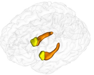 Figure : Segmentation automatique des hippocampes (orange) et des amygdales (jaune) à partir de données d’imagerie par résonance magnétique (IRM) grâce au logiciel SACHA. © Ludovic Fillon, Marie Chupin, Equipe ARAMIS