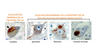 Neuroinflammation