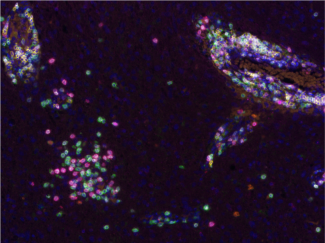 marquage multiplex de lymphocytes dans un échantillon de tumeur cerebrale