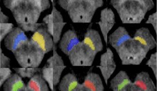 Images sensibles à la neuromélanine