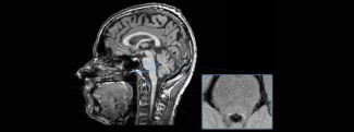 Le complexe coeruleus/subcoeruleus est visible dans cette nouvelle sequence IRM. Cela nous a permis d’étudier la relation entre cette petite structure (en blanc dans l’image) et le tonus musculaire pendant le sommeil paradoxal.