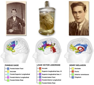 Les voies du cerveau endommagées dans les trois cas historiques étudiés 