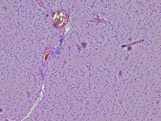 glioblastomes