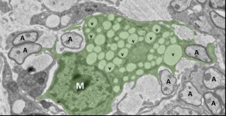 Macrophage (M, vert) dans une lésion de démyélinisation ; il nettoie la lésion près des axones (A) et élimine les débris par les vacuoles (v). Ce type cellulaire participe aussi à l’orchestration de la réparation de la myéline. Crédit : Institut du Cervea