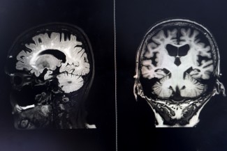 brain MRI for education Dementia Mix type stroke VaD