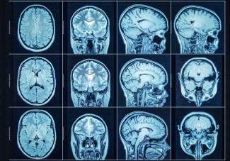 L’IRM structurelle ne permet pas, à elle seule, de diagnostiquer la dépression