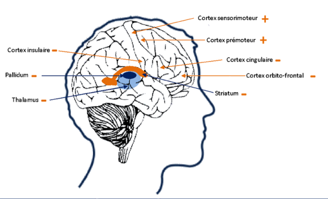 Quels Sont Les M canismes Biologiques Du Syndrome De Gilles De La quels-sont-les-m-canismes-biologiques-du-syndrome-de-gilles-de-la