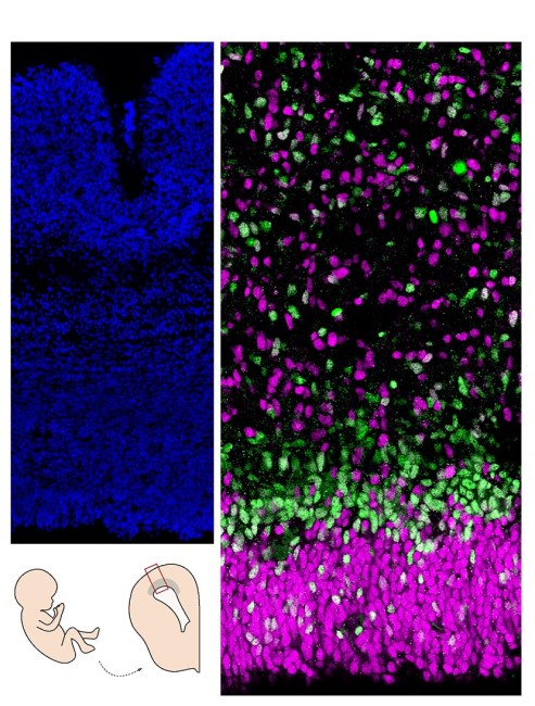 Coupe de cerveau humain (cortex). A gauche, les noyaux sont marqués en bleu; à droite, les cellules progénitrices en magenta sont moins engagées dans la différentiation neuronale que celles en vert. © Monia Barnat/Grenoble Institut des Neurosciences/Inserm, Université Grenoble Alpes