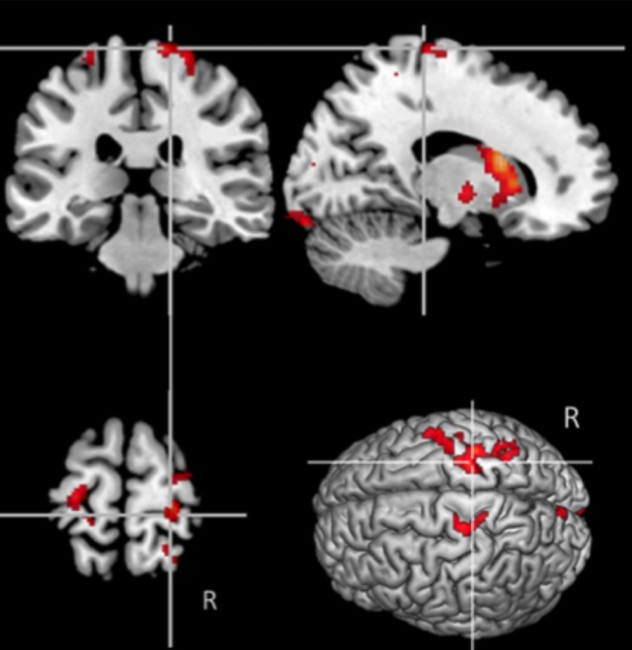 hypermétabolisme cérébral