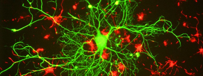 Forme rare et précoce de la maladie d’Alzheimer : hyperconnecter les ...
